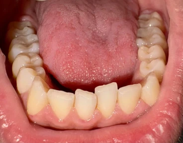 отпечатък за алайнери