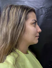 отпечатък за алайнери