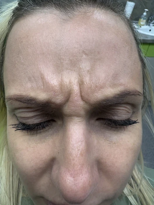 поставяне на ботокс