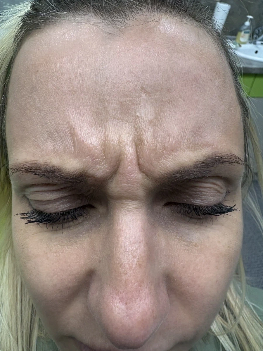 поставяне на ботокс - Reservation.Studio