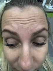 поставяне на ботокс поставяне на ботокс