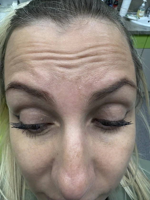 поставяне на ботокс - Reservation.Studio