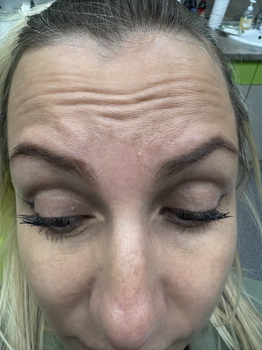 поставяне на ботокс - Reservation.Studio