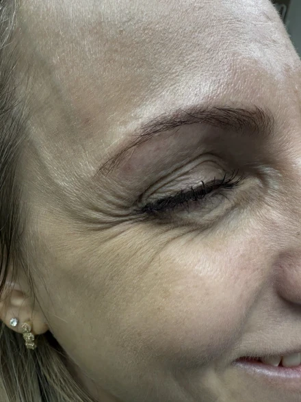 поставяне на ботокс поставяне на ботокс