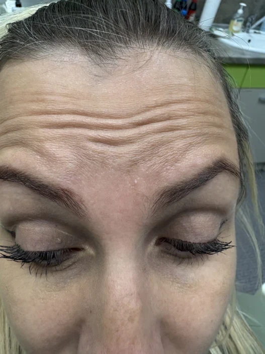 поставяне на ботокс