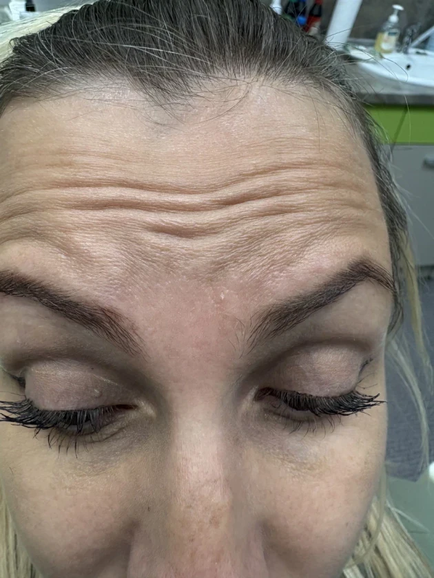 поставяне на ботокс - Reservation.Studio