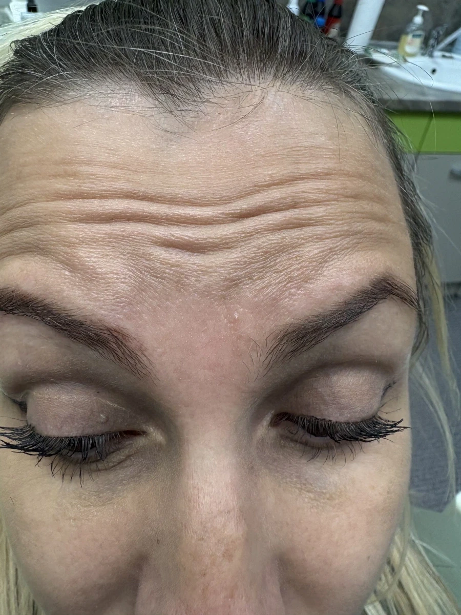 поставяне на ботокс - Reservation.Studio поставяне на ботокс - Reservation.Studio