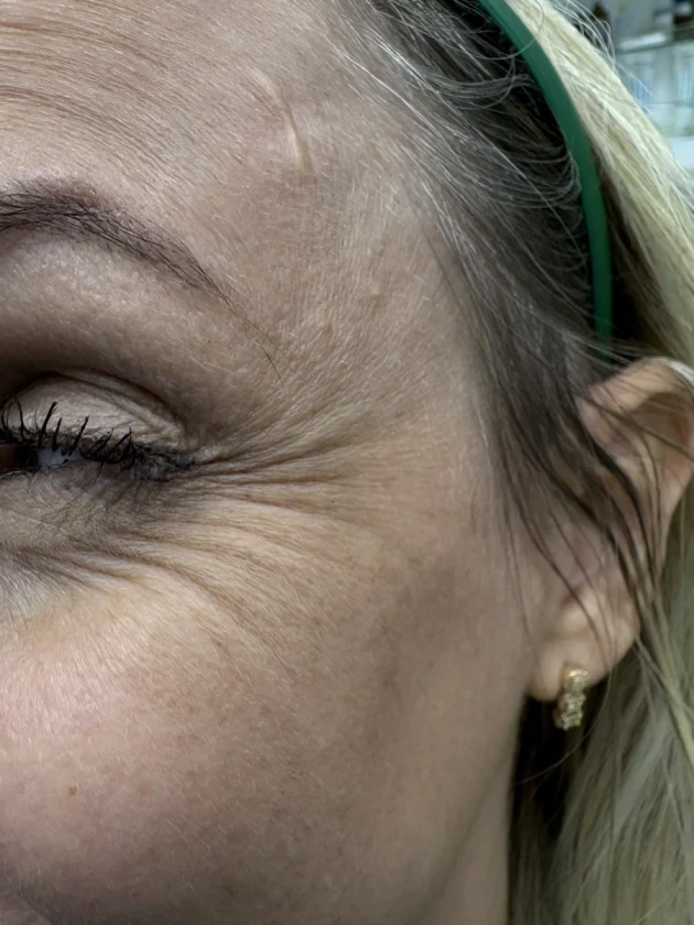 поставяне на ботокс - Reservation.Studio поставяне на ботокс - Reservation.Studio