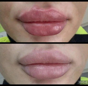 поставяне на филър поставяне на филър