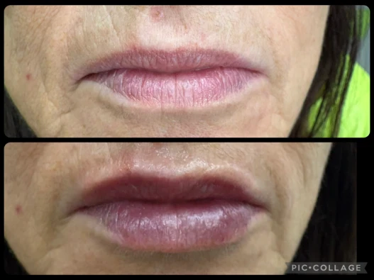 поставяне на филър поставяне на филър