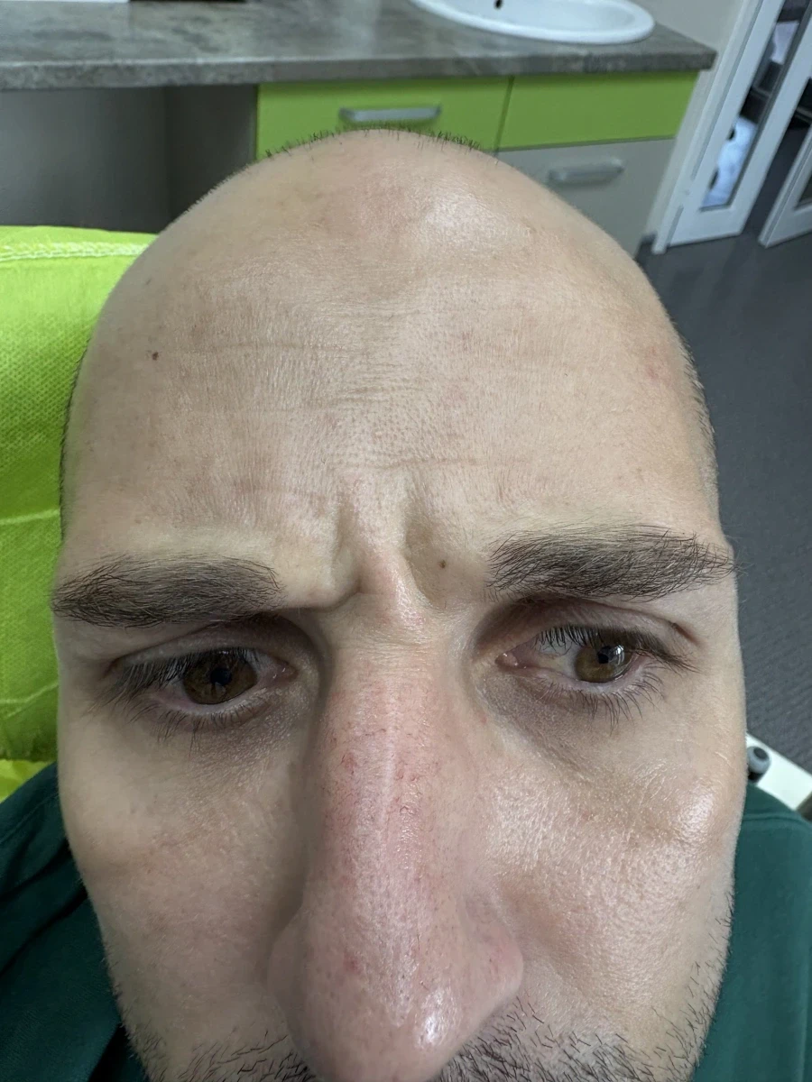 поставяне на ботокс - Reservation.Studio