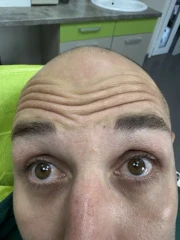 поставяне на ботокс поставяне на ботокс