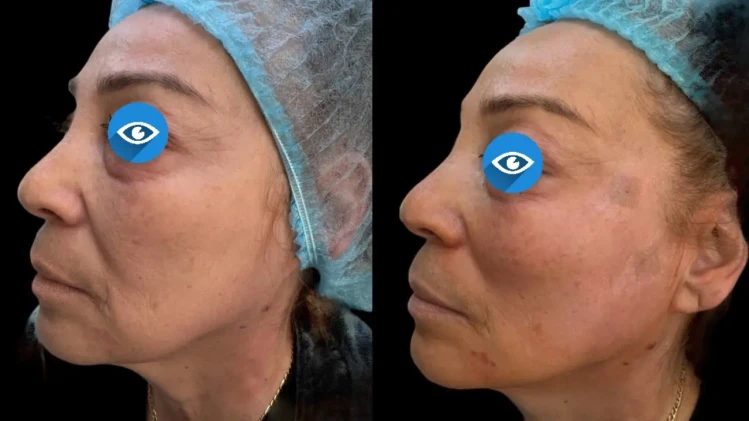 🪡 Тредлифтинг с конци Aptos