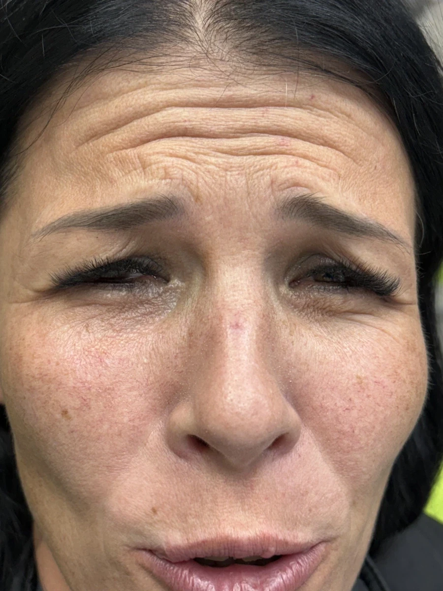 поставяне на ботокс - Reservation.Studio поставяне на ботокс - Reservation.Studio