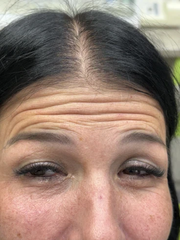 поставяне на ботокс поставяне на ботокс