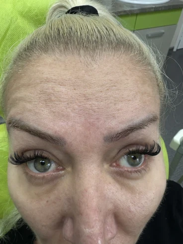 поставяне на ботокс поставяне на ботокс