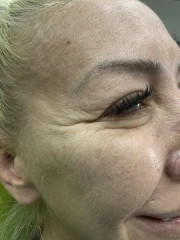 поставяне на ботокс