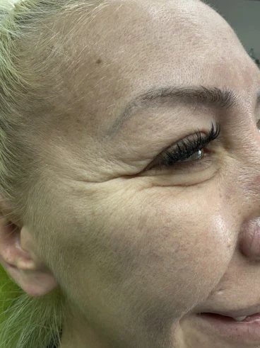 поставяне на ботокс