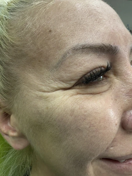 поставяне на ботокс поставяне на ботокс