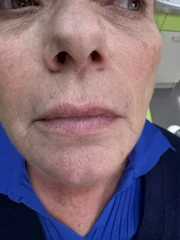 поставяне на филър поставяне на филър