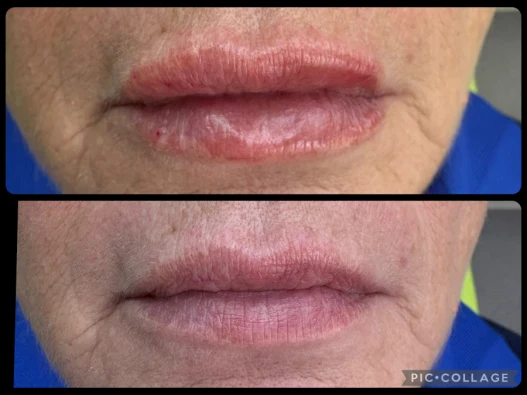 поставяне на филър