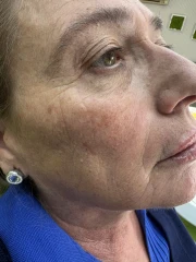 поставяне на филър поставяне на филър