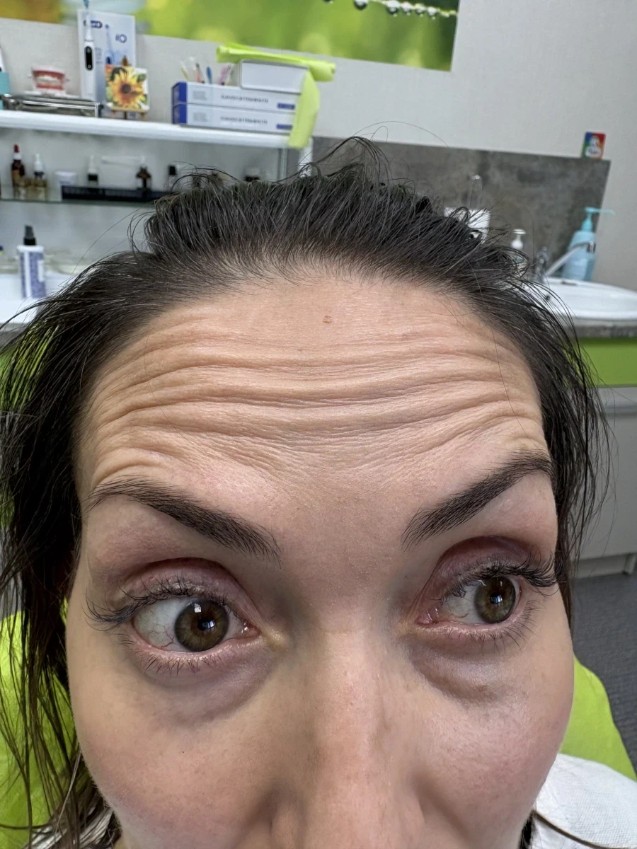 поставяне на ботокс - Reservation.Studio поставяне на ботокс - Reservation.Studio