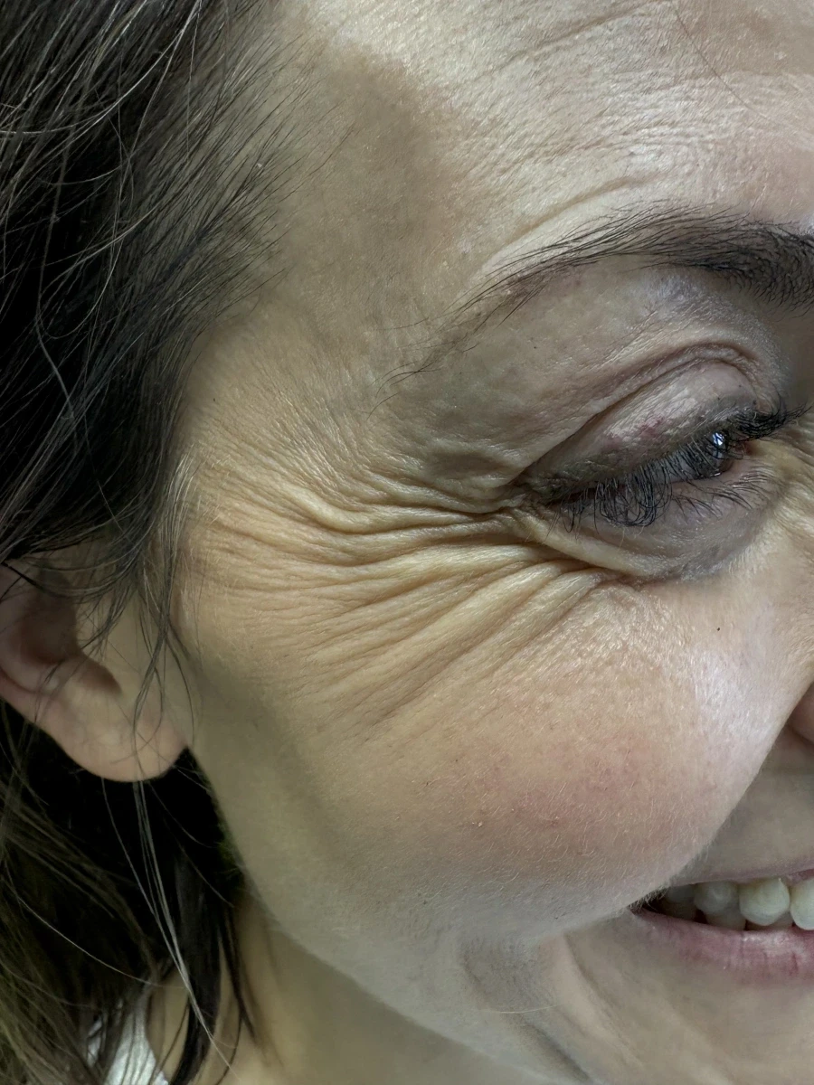 поставяне на ботокс - Reservation.Studio поставяне на ботокс - Reservation.Studio