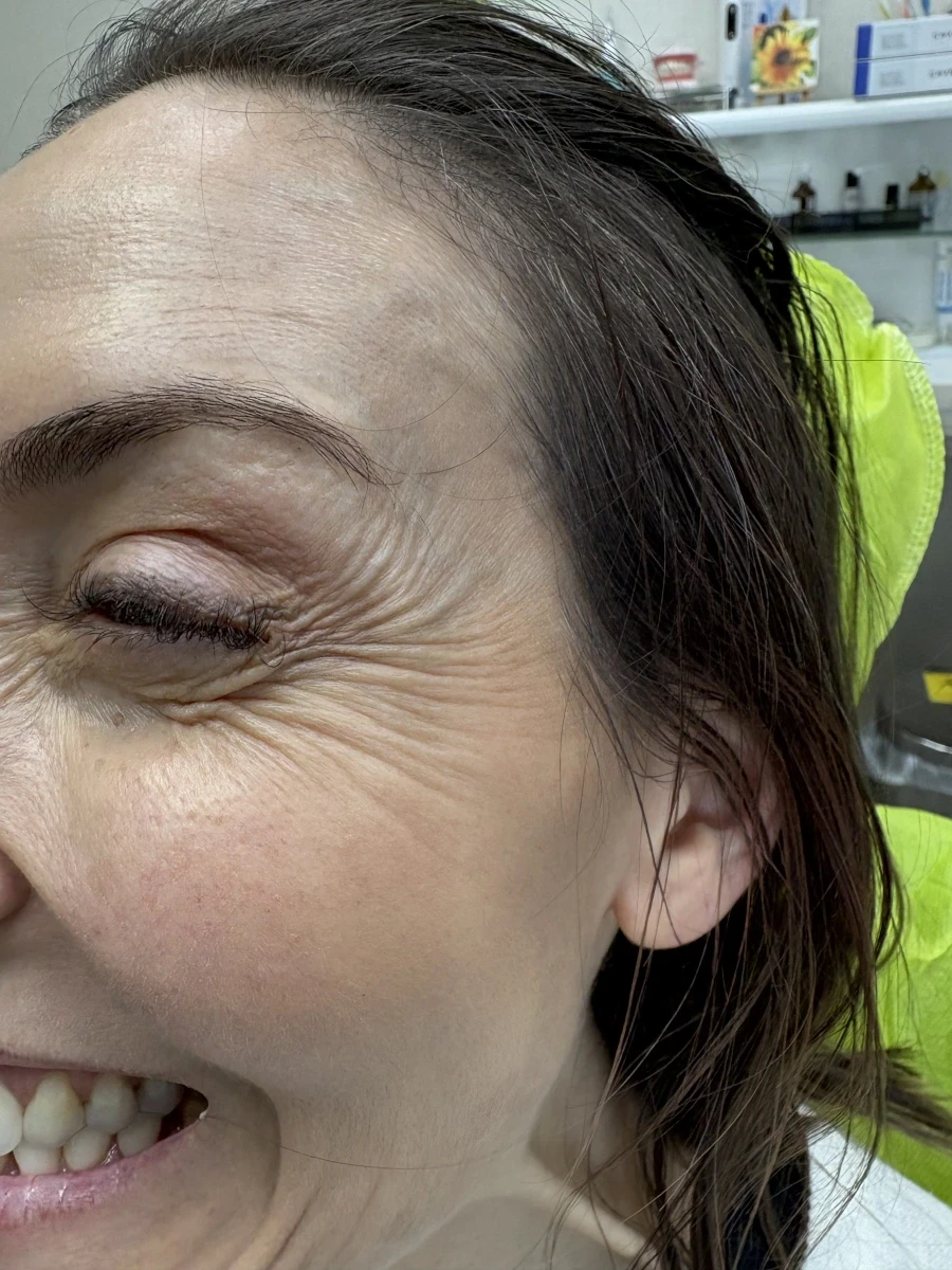 поставяне на ботокс - Reservation.Studio