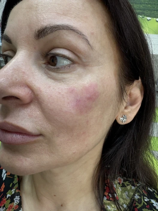 поставяне на филър