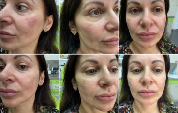 поставяне на филър