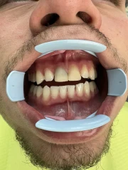 отпечатък за мост отпечатък за мост