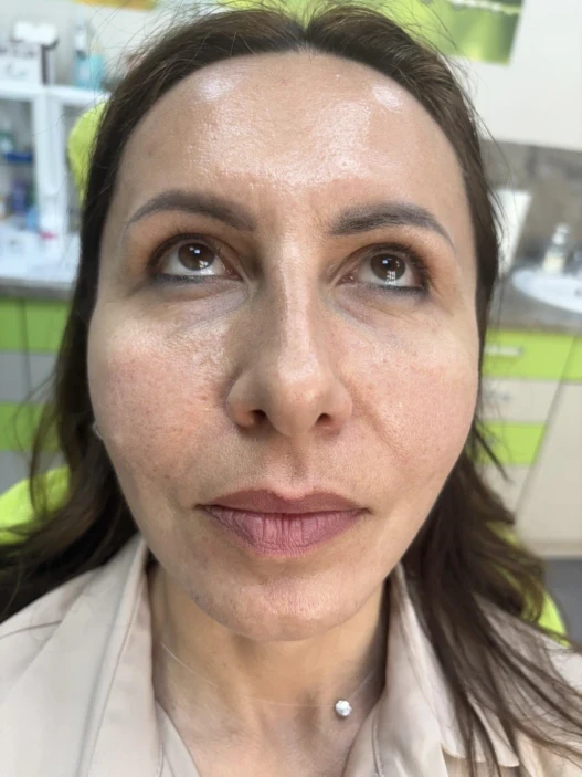 поставяне на филър поставяне на филър