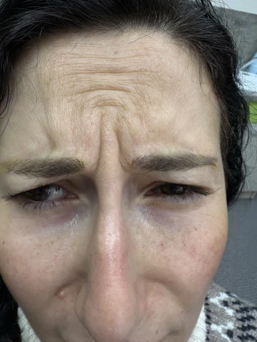 поставяне на ботокс