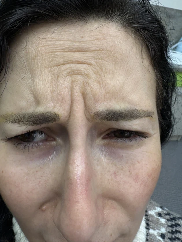 поставяне на ботокс - Reservation.Studio