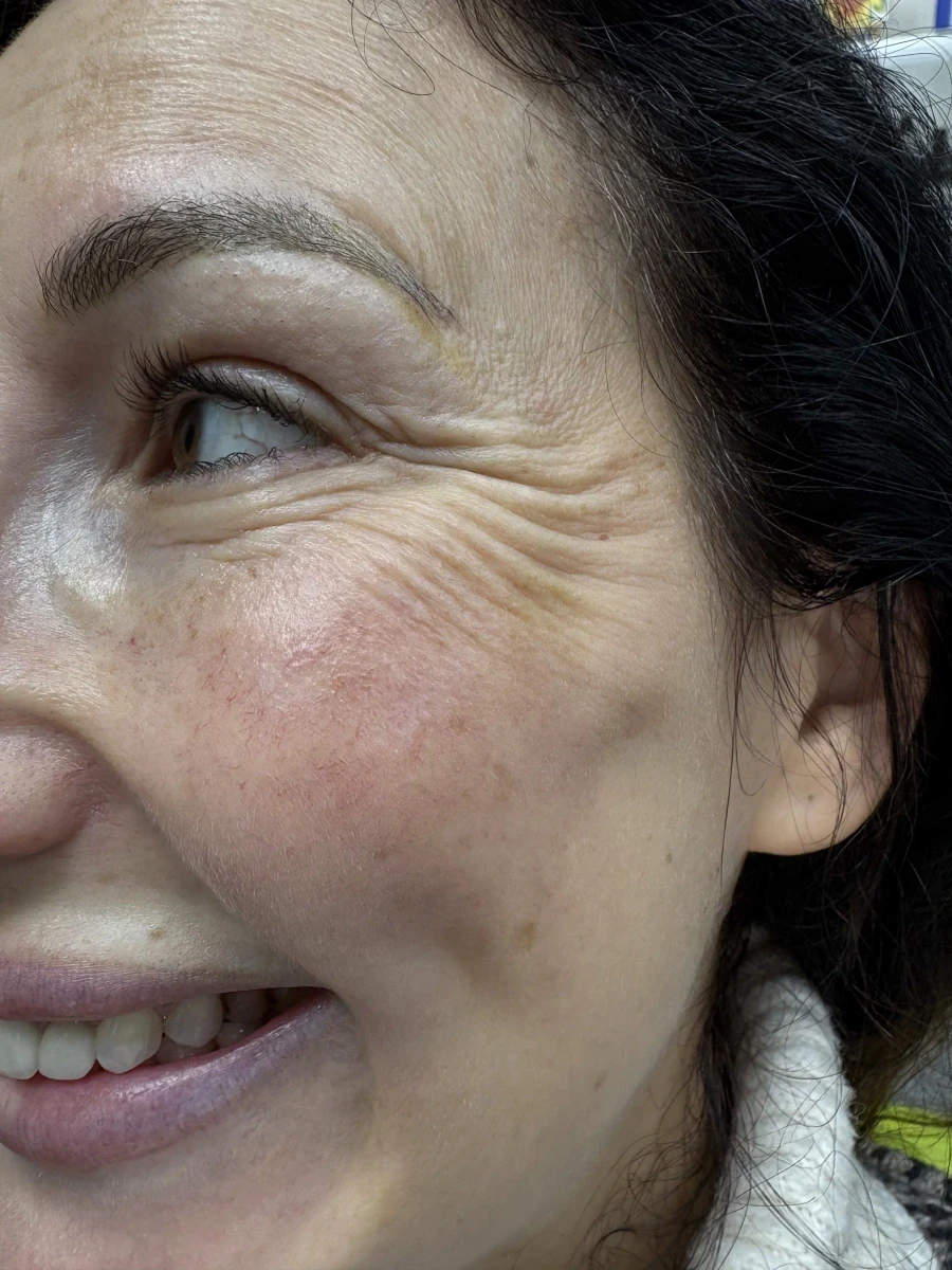 поставяне на ботокс - Reservation.Studio