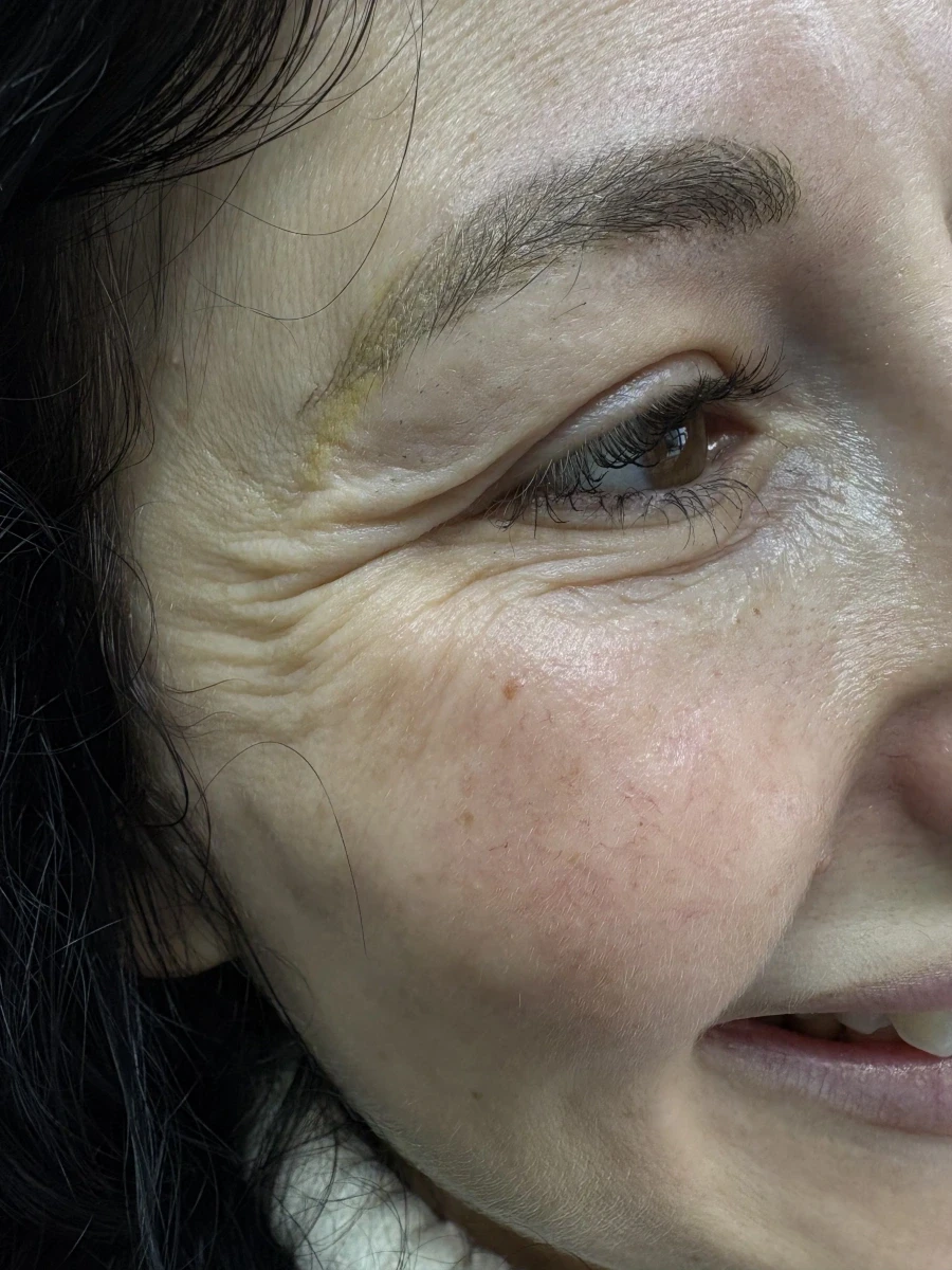 поставяне на ботокс - Reservation.Studio поставяне на ботокс - Reservation.Studio