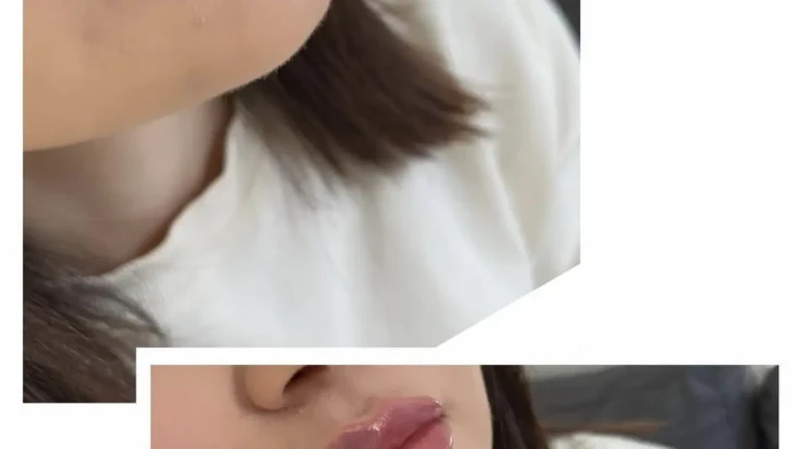 Juvederm ULTRA 3 1 ml Juvederm ULTRA 3 1 ml