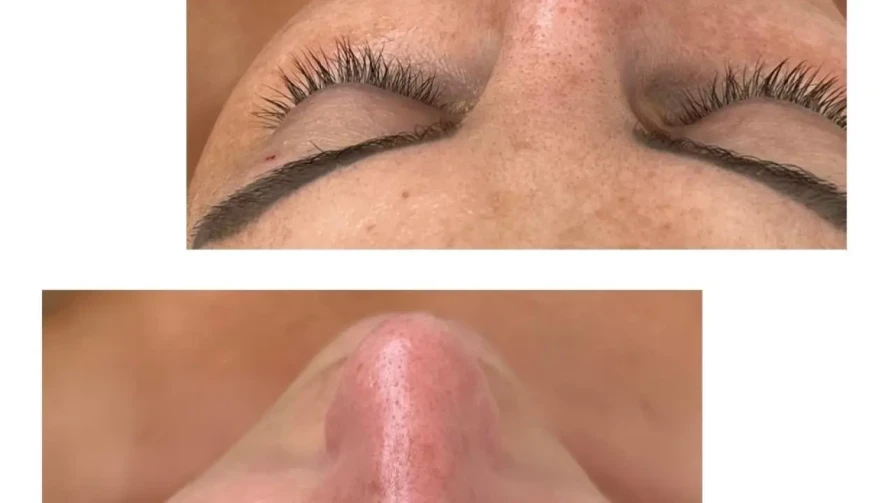 Почистване на лице с Forlle`d Почистване на лице с Forlle`d