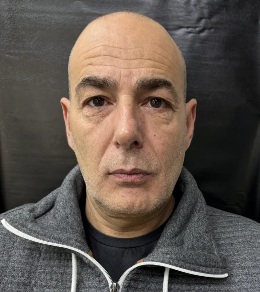 отпечатък за алайнери