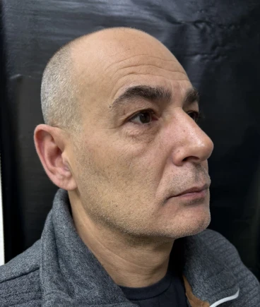 отпечатък за алайнери отпечатък за алайнери