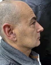 отпечатък за алайнери