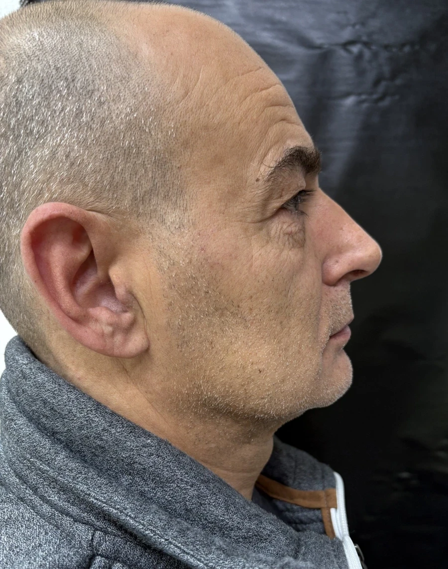 отпечатък за алайнери - Reservation.Studio