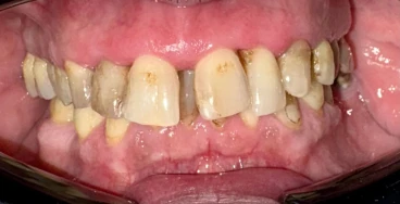 отпечатък за алайнери