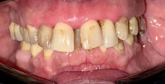 отпечатък за алайнери отпечатък за алайнери