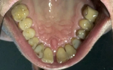 отпечатък за алайнери