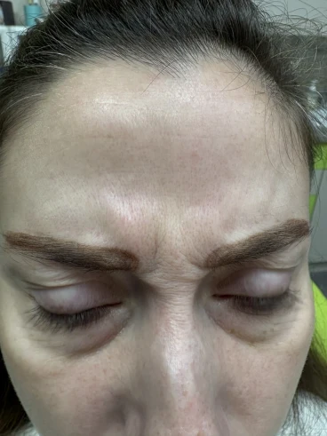 поставяне на ботокс