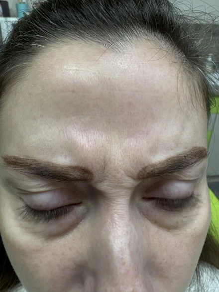 поставяне на ботокс