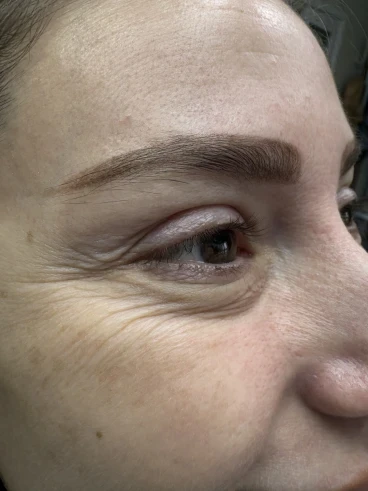 поставяне на ботокс