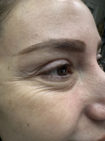 поставяне на ботокс